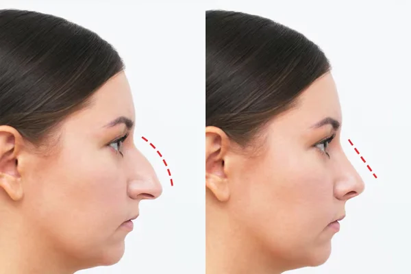 Rhinoplasty