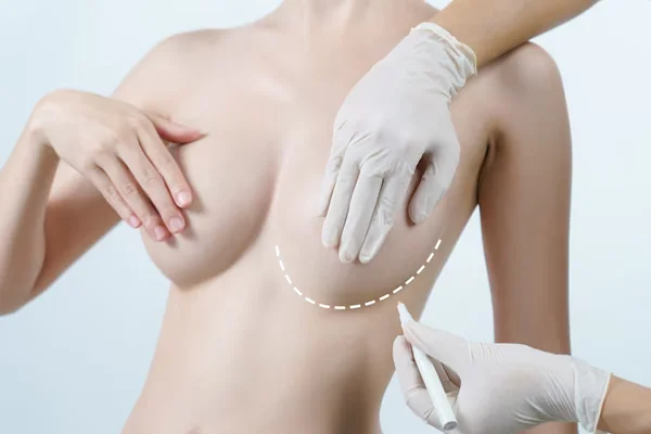 Breast Lift